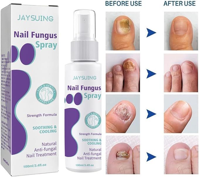 100ml Nail Fungus Spray Soothing and Cooling Treatment Spray with Free Shipping
