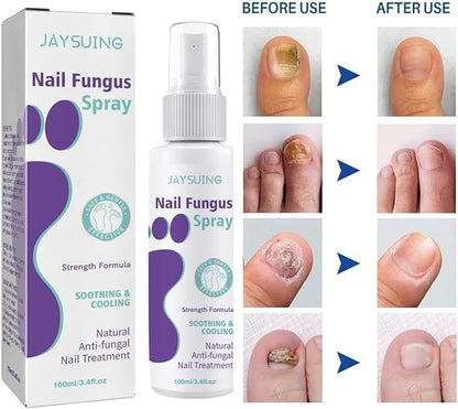 100ml Nail Fungus Spray Soothing and Cooling Treatment Spray with Free Shipping